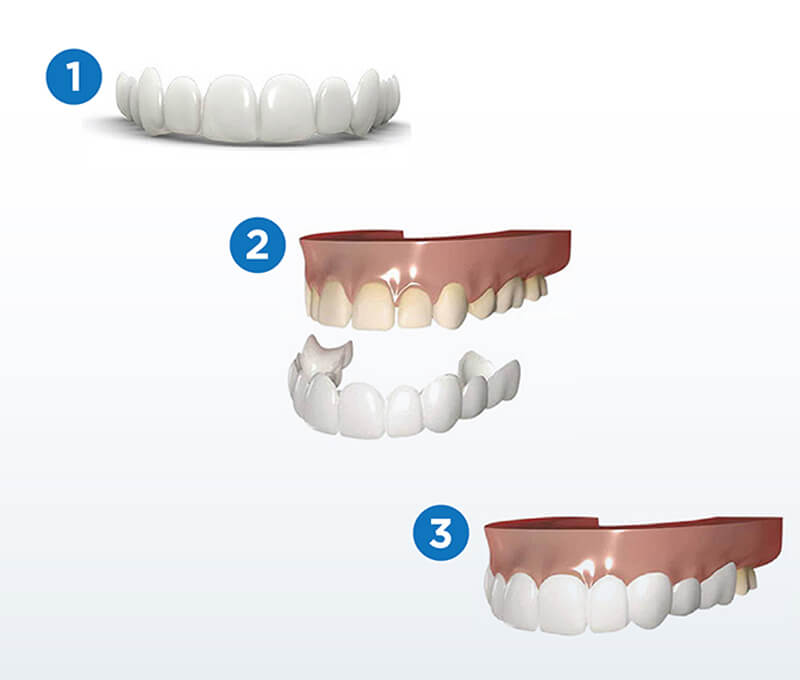 ครอบฟันขาวแบบถอดได้ Snap On Smile