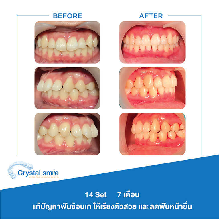 ครอบฟันขาว, คลินิกจัดฟัน, คลินิกทันตกรรม, จัดฟัน, จัดฟัน invisalign, จัดฟันแบบใส, ฟอกสีฟัน, ฟอกสีฟัน zoom, รักษารากฟัน, รากฟันเทียม, วีเนียร์, เพลินจิต, สีลม, สุขุมวิท, อโศก