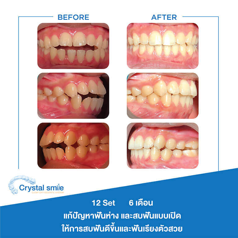 ครอบฟันขาว, คลินิกจัดฟัน, คลินิกทันตกรรม, จัดฟัน, จัดฟัน invisalign, จัดฟันแบบใส, ฟอกสีฟัน, ฟอกสีฟัน zoom, รักษารากฟัน, รากฟันเทียม, วีเนียร์, เพลินจิต, สีลม, สุขุมวิท, อโศก