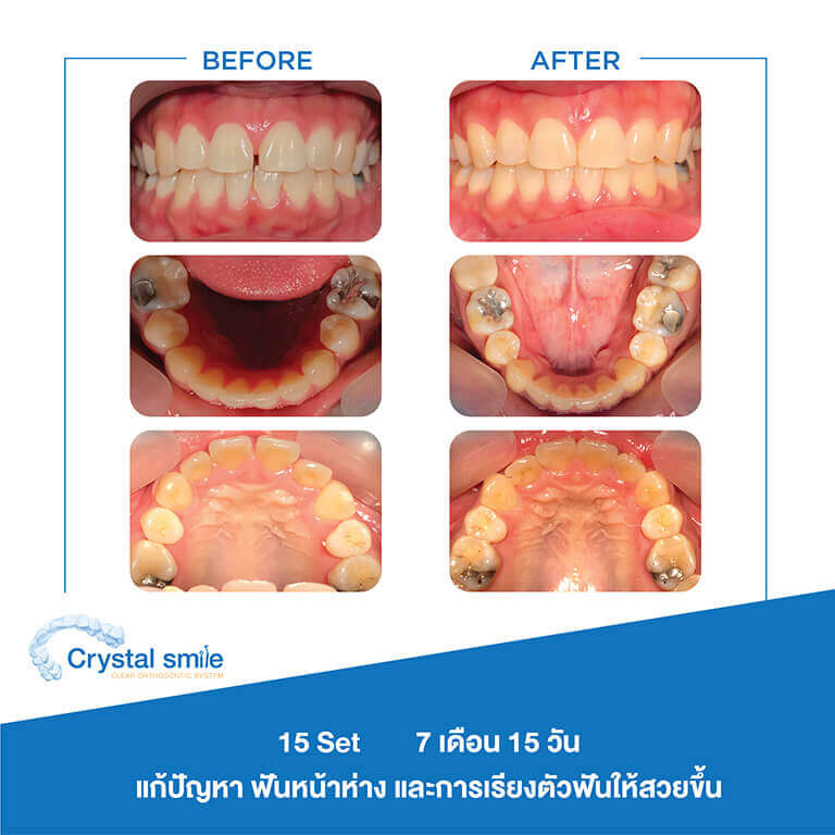 ครอบฟันขาว, คลินิกจัดฟัน, คลินิกทันตกรรม, จัดฟัน, จัดฟัน invisalign, จัดฟันแบบใส, ฟอกสีฟัน, ฟอกสีฟัน zoom, รักษารากฟัน, รากฟันเทียม, วีเนียร์, เพลินจิต, สีลม, สุขุมวิท, อโศก