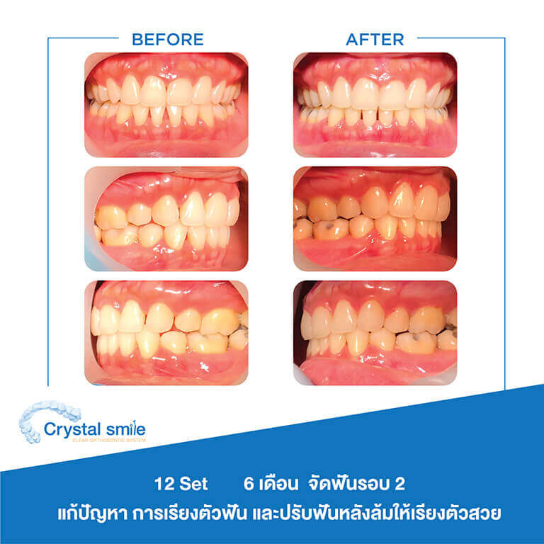 ครอบฟันขาว, คลินิกจัดฟัน, คลินิกทันตกรรม, จัดฟัน, จัดฟัน invisalign, จัดฟันแบบใส, ฟอกสีฟัน, ฟอกสีฟัน zoom, รักษารากฟัน, รากฟันเทียม, วีเนียร์, เพลินจิต, สีลม, สุขุมวิท, อโศก