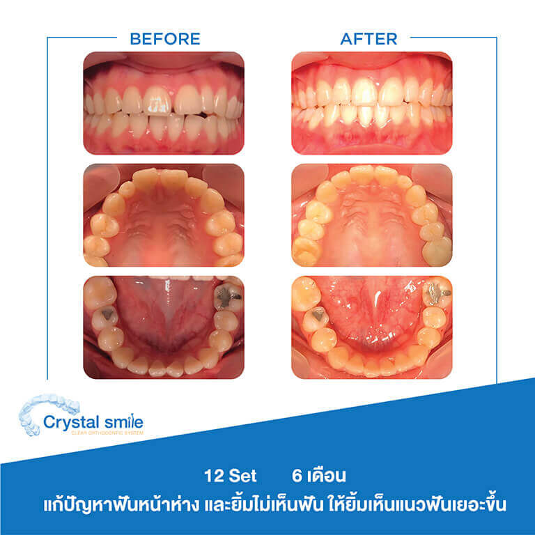 ครอบฟันขาว, คลินิกจัดฟัน, คลินิกทันตกรรม, จัดฟัน, จัดฟัน invisalign, จัดฟันแบบใส, ฟอกสีฟัน, ฟอกสีฟัน zoom, รักษารากฟัน, รากฟันเทียม, วีเนียร์, เพลินจิต, สีลม, สุขุมวิท, อโศก