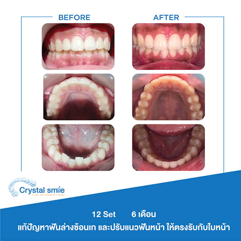 ครอบฟันขาว, คลินิกจัดฟัน, คลินิกทันตกรรม, จัดฟัน, จัดฟัน invisalign, จัดฟันแบบใส, ฟอกสีฟัน, ฟอกสีฟัน zoom, รักษารากฟัน, รากฟันเทียม, วีเนียร์, เพลินจิต, สีลม, สุขุมวิท, อโศก