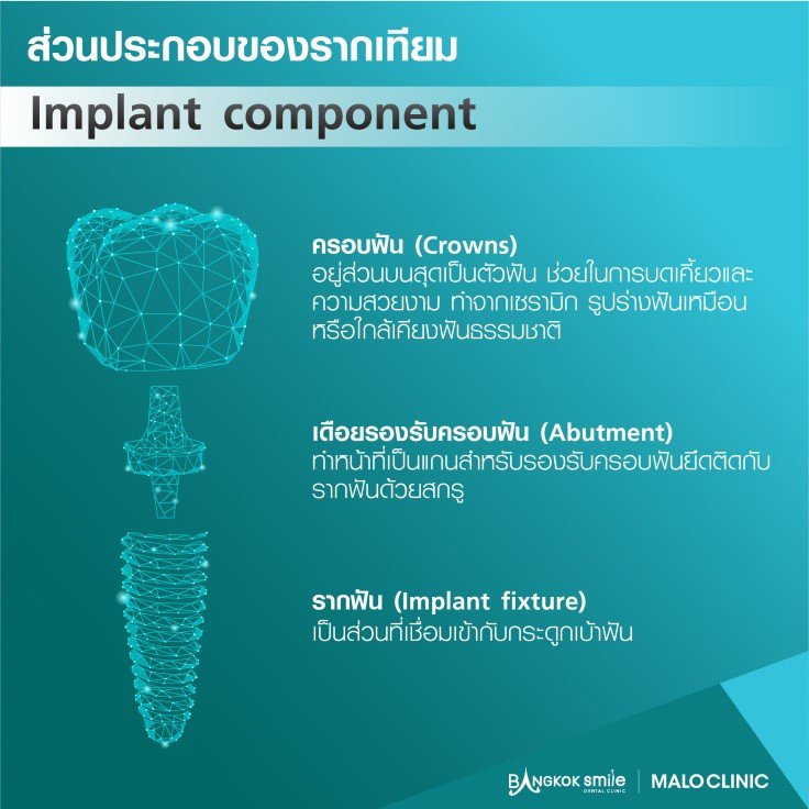 ครอบฟันขาว, คลินิกจัดฟัน, คลินิกทันตกรรม, จัดฟัน, จัดฟัน invisalign, จัดฟันแบบใส, ฟอกสีฟัน, ฟอกสีฟัน zoom, รักษารากฟัน, รากฟันเทียม, วีเนียร์, เพลินจิต, สีลม, สุขุมวิท, อโศก