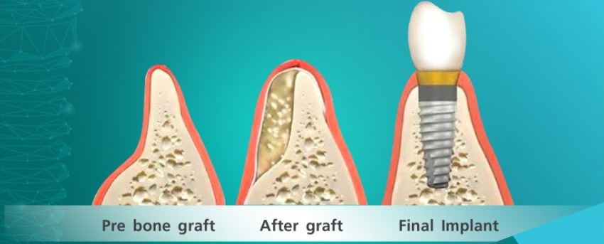 รากฟันเทียม,ครอบฟันขาว,คลินิกจัดฟัน,คลินิกทันตกรรม,จัดฟัน,จัดฟัน invisalign,จัดฟันแบบใส,ฟอกสีฟัน,ฟอกสีฟัน zoom,รักษารากฟัน,วีเนียร์,เพลินจิต,สีลม,สุขุมวิท,อโศก,ครอบฟัน,ครอบฟันราคา,ราคาครอบฟัน,ครอบฟันหน้า,ครอบ ฟัน ที่ไหน ดี,ทำครอบฟัน,การครอบฟัน,ครอบฟันราคาถูก,ครอบฟันราคาเท่าไหร่,ครอบฟันเซรามิก,ที่ครอบฟัน