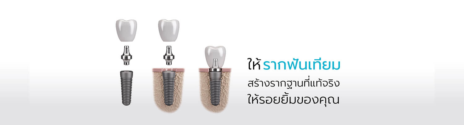 ครอบฟันขาว, คลินิกจัดฟัน, คลินิกทันตกรรม, จัดฟัน, จัดฟัน invisalign, จัดฟันแบบใส, ฟอกสีฟัน, ฟอกสีฟัน zoom, รักษารากฟัน, รากฟันเทียม, วีเนียร์, เพลินจิต, สีลม, สุขุมวิท, อโศก