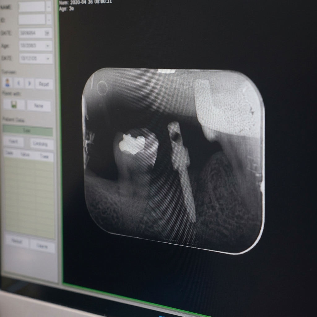 Single Implant X-Ray Result