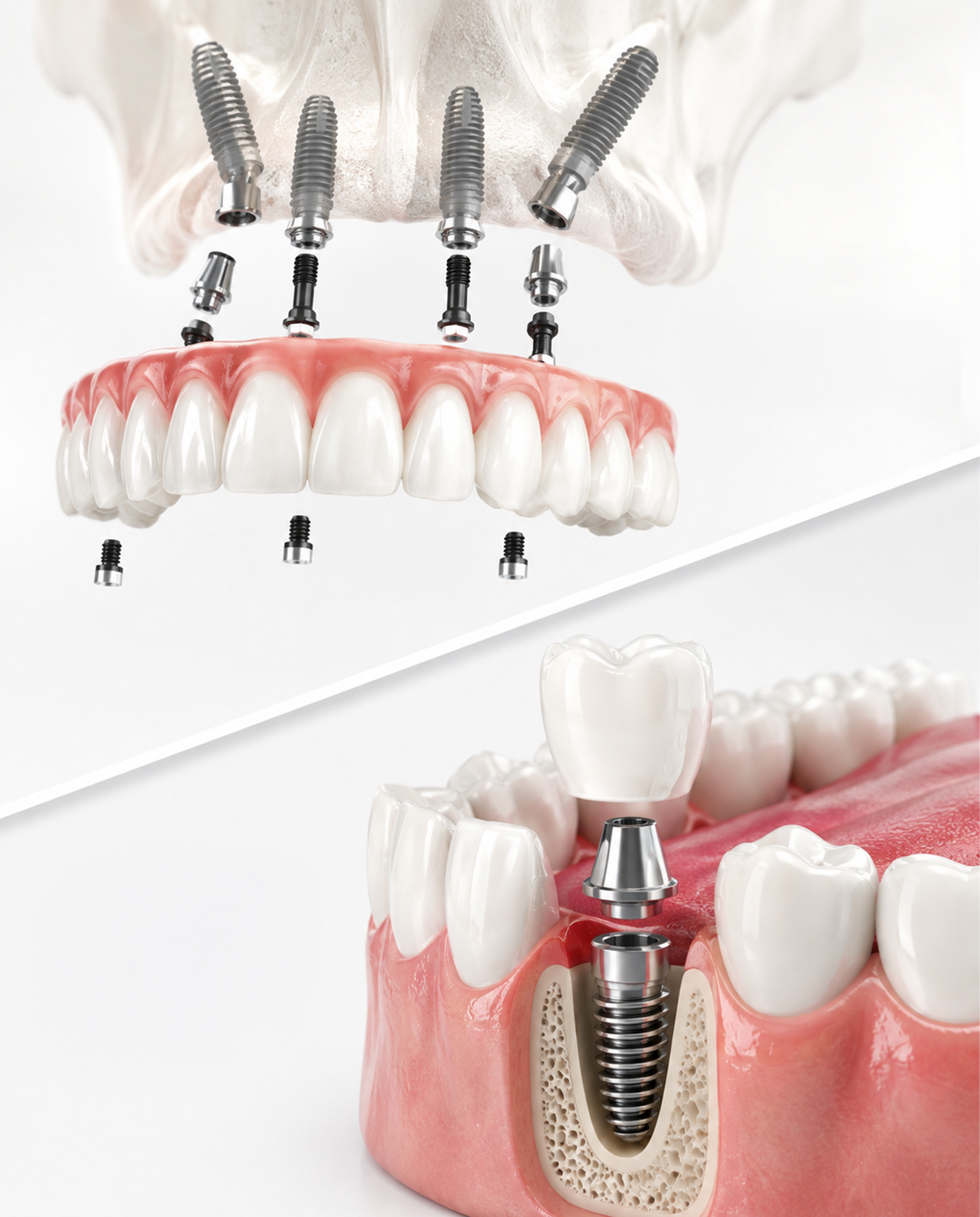 IMPLANT - ALL ON 4รากฟันเทียม - รากฟันเทียมทั้งปาก