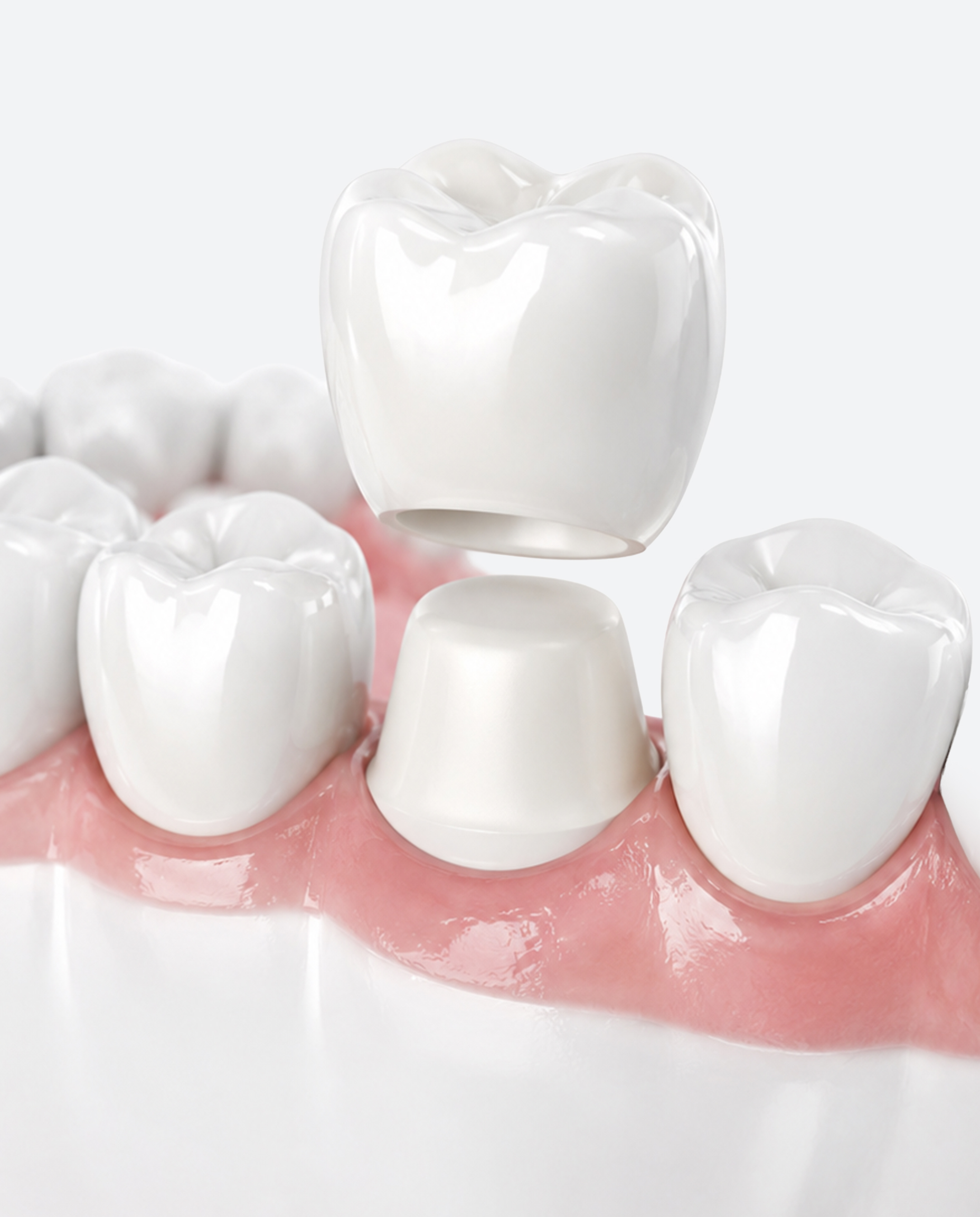DENTAL CROWNครอบฟัน